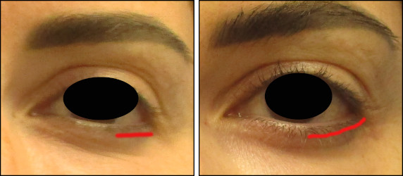 facelift